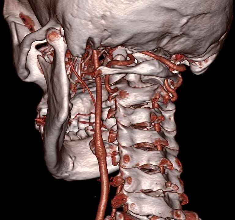 Arteria pinzada con osteocondrosis cervical