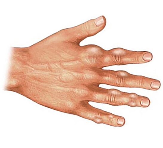 Deposición de cristales de ácido úrico en los tejidos blandos de los dedos en la artritis gotosa