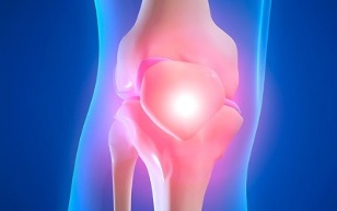 Causas de la osteoartritis de la articulación de la rodilla. 