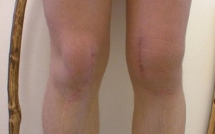 Etapas de desarrollo de la osteoartritis de rodilla