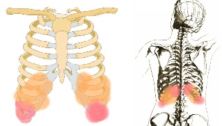 el dolor de espalda bajo las costillas síntomas