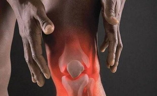 La osteoartritis se acompaña de un proceso inflamatorio en la articulación de la rodilla. 